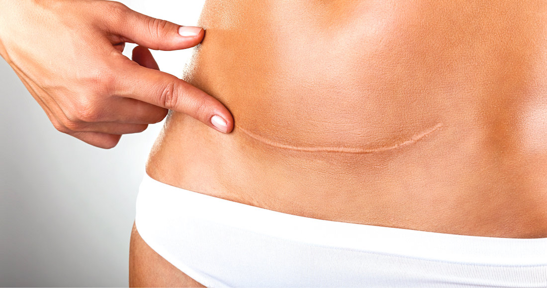25+ Queloide Cicatriz Abdominoplastia Images